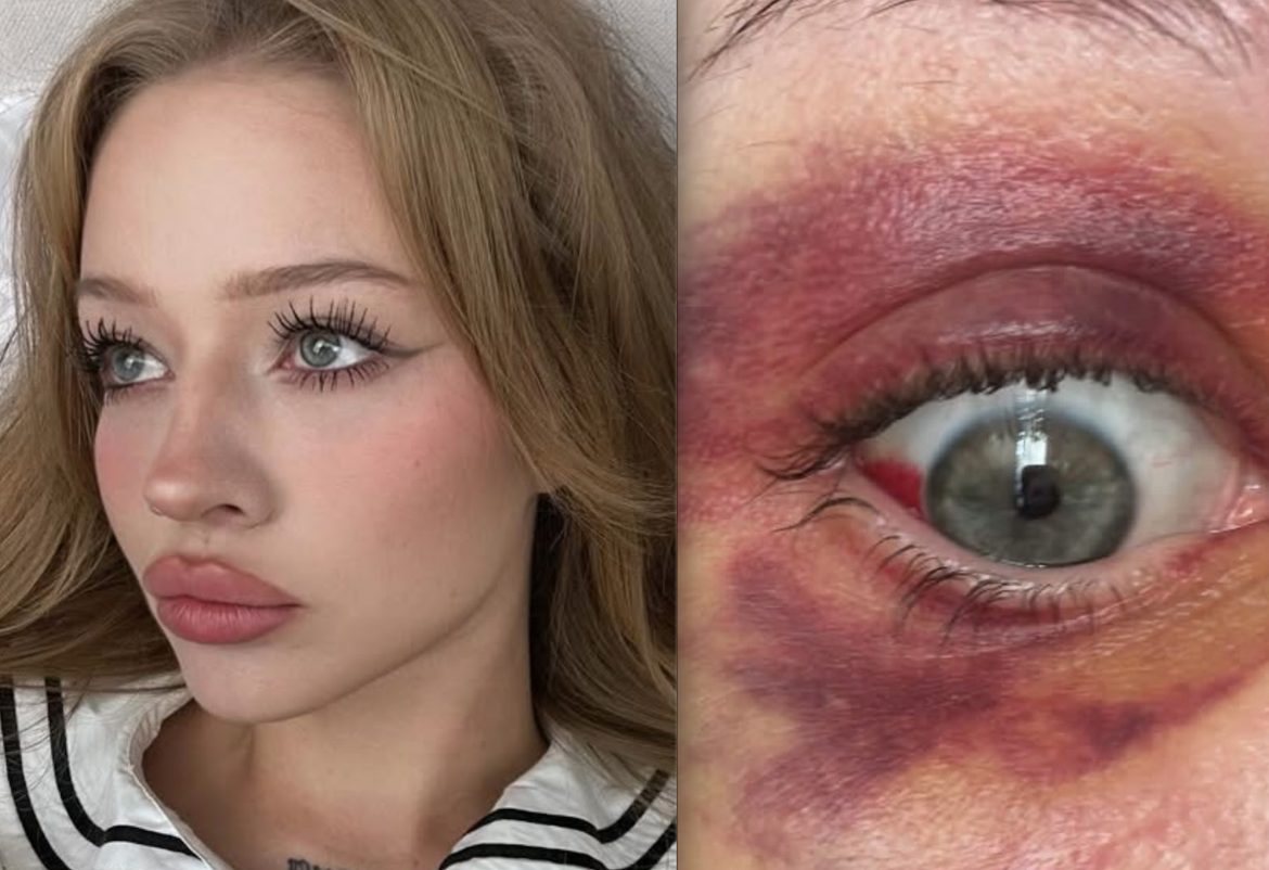 Koszmar powraca? Kolejna partnerka oskarża Kartky’ego o pobicie i pokazuje zdjęcia