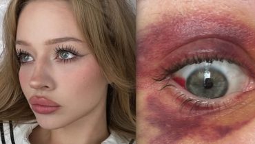 Koszmar powraca? Kolejna partnerka oskarża Kartky’ego o pobicie i pokazuje zdjęcia