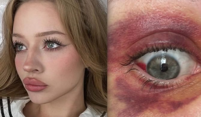 Koszmar powraca? Kolejna partnerka oskarża Kartky’ego o pobicie i pokazuje zdjęcia